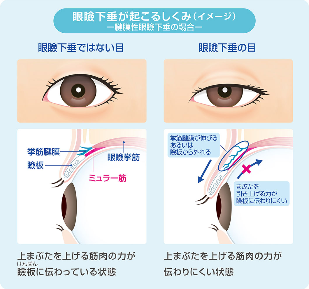 アップニークミニの作用と効果