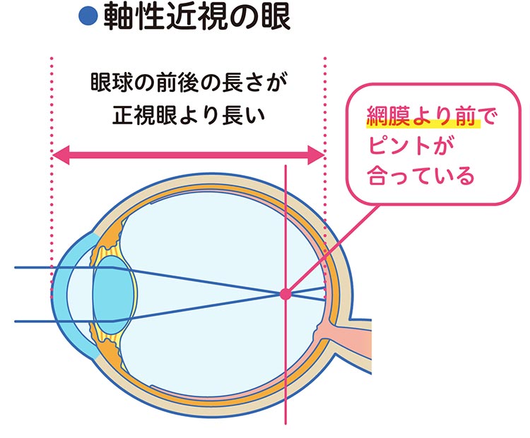 小児の近視について